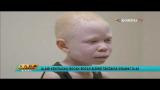 Download Video Lagu Nasib Buruk Anak-anak Albino dari Tanzania Gratis - zLagu.Net
